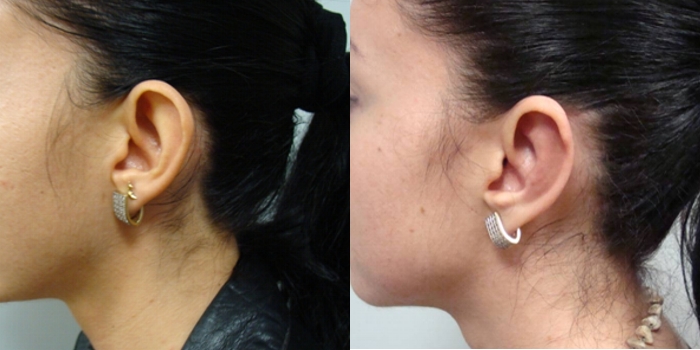 Otoplastika, nakon mjesec dana